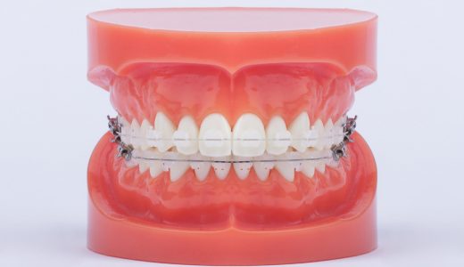 Signature III aesthetic ceramic brackets, with aesthetic wire on the upper jaw, and normal metal wire on the lower jaw