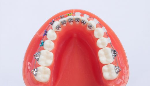 i-TTR metal bracket “Internal orthodontics”