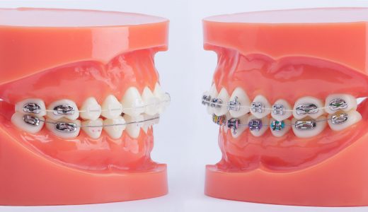 Comparing aesthetic and metal orthodonic systems