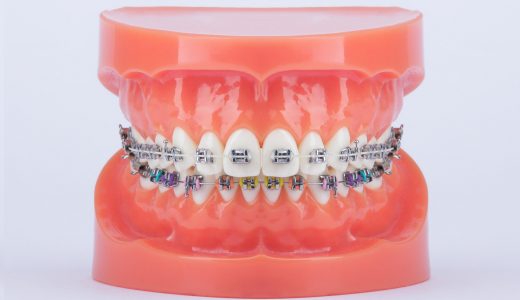 Modern Orthodontics Sapphire Metall-Brackets