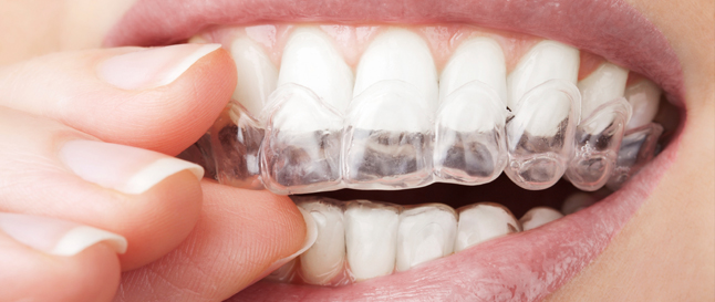 Clear-Aligner, hogy legyen átlátszó fogszabályozás is:)